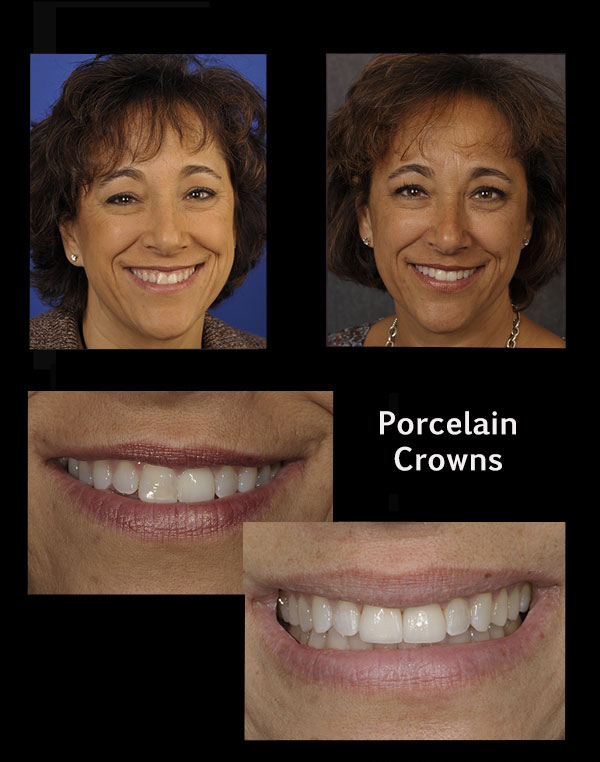 before and after of a patient who received porcelain crowns