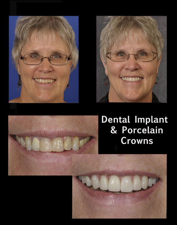 before and after of a patient who received a dental implant and porcelain crowns