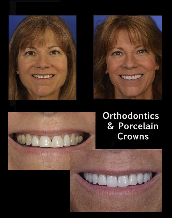 before and after of a patient who received orthodontics and porcelain crowns