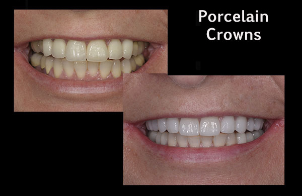 before and after of a patient with porcelain crowns