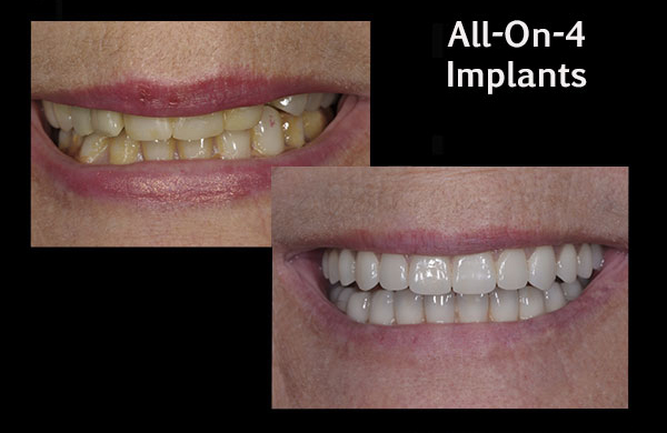 before and after of a patient with all-on-4 implants