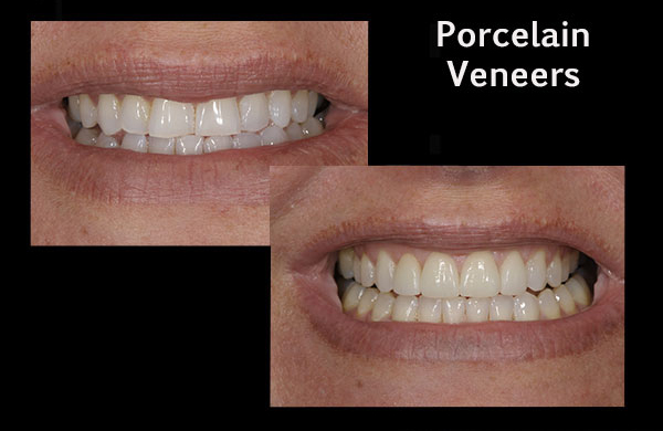 before and after of a patient who received porcelain veneers