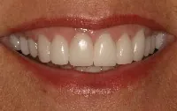 A woman's smile after her PFM crowns were replaced with porcelain crowns.