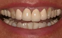 Photo of a patient's smile before her PFM crowns were replaced with porcelain ones.
