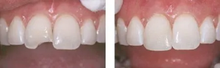 Before and after photos showing the how a chipped front left tooth was beautifully restored through dental bonding.