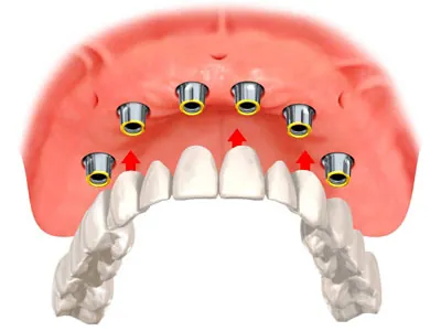 Drawing of an upper implant bridge, our premium option in implant-supported dentures.