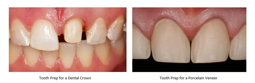 Side-by-side photos comparing tooth preparation for a crown with tooth preparation for porcelain veneers.