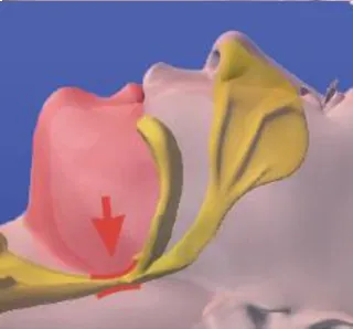 Rendering that shows the narrowing of the breathing passage which causes snoring, a symptom of sleep apnea.