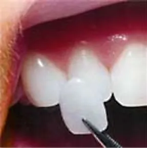 A porcelain veneer being help up to a tooth