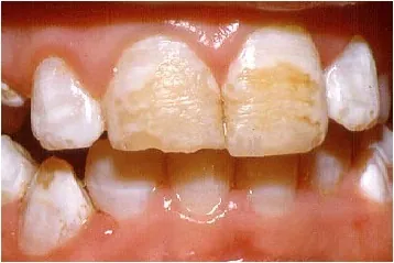 Severe enamel hypoplasia