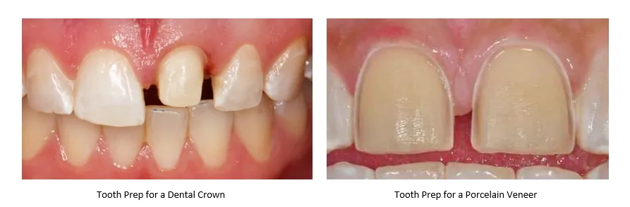 Tooth prep for crowns versus veneers