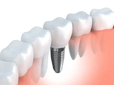 A dental implant placed in between several teeth