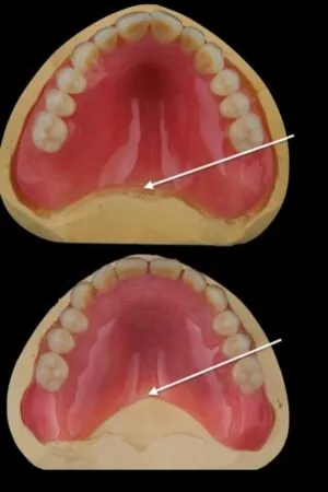 Two images of dentures. One with the denture plate adjusted.