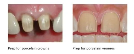 Tooth preparation for crowns and veneers