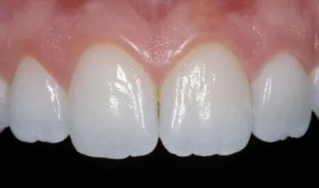 Beautiful teeth that have one that is fake