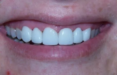 A poorly done smile makeover with tetracycline stains